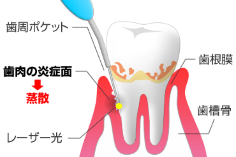 歯周病予防ではプラークコントロールが欠かせません​
